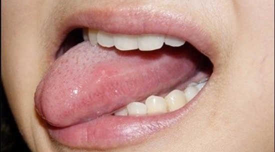 혓바늘의-원인과-효과적인-예방-및-치료법-썸네일