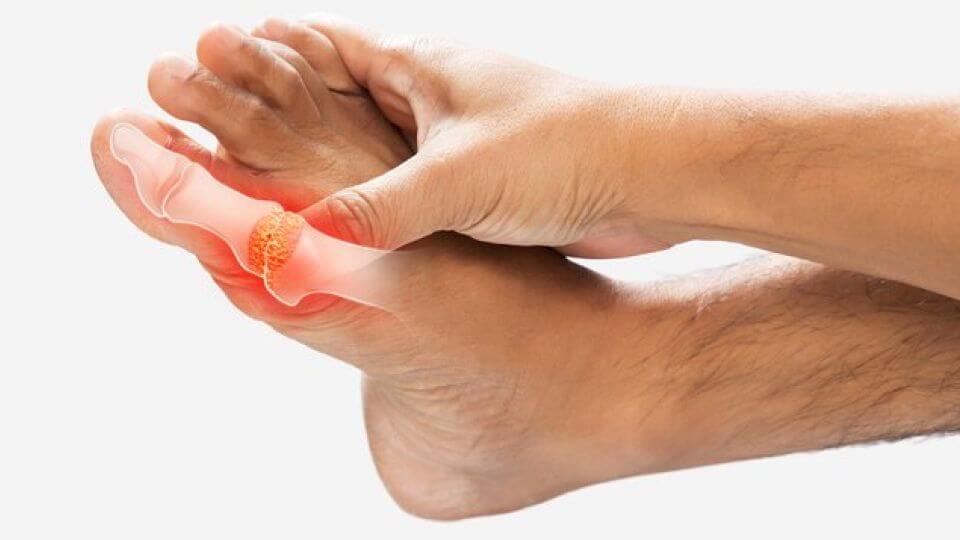 통풍과 요산의 관련성 그리고 임상결과들