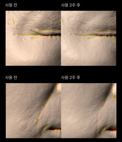 반코르 고주파 마사지기 효과