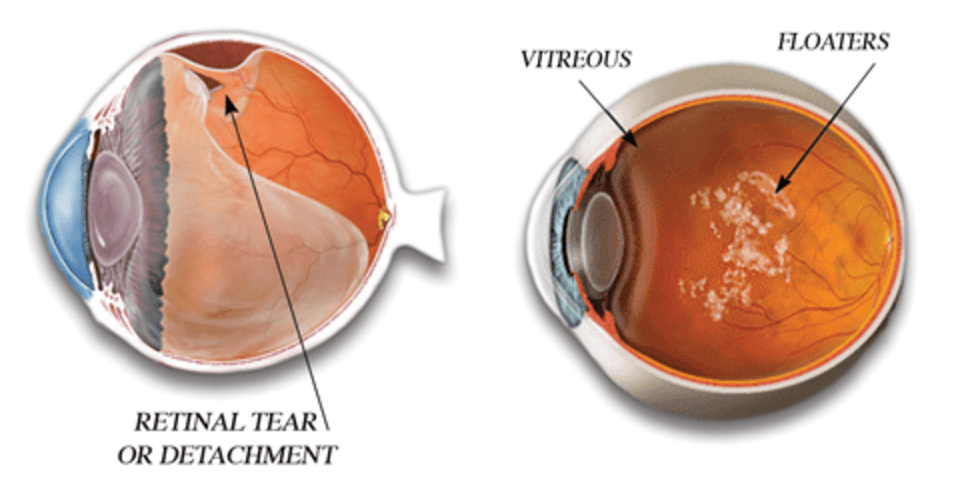 비문증 파인애플