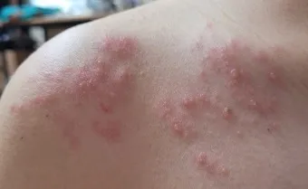 대상포진 감염 증상 부위 손 허리 허벅지_10