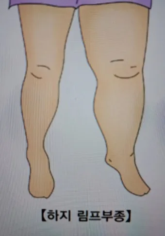 부종의 원인과 증상 5가지 개선방법 치료법_14
