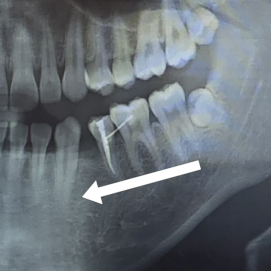 사랑니 이동 교정