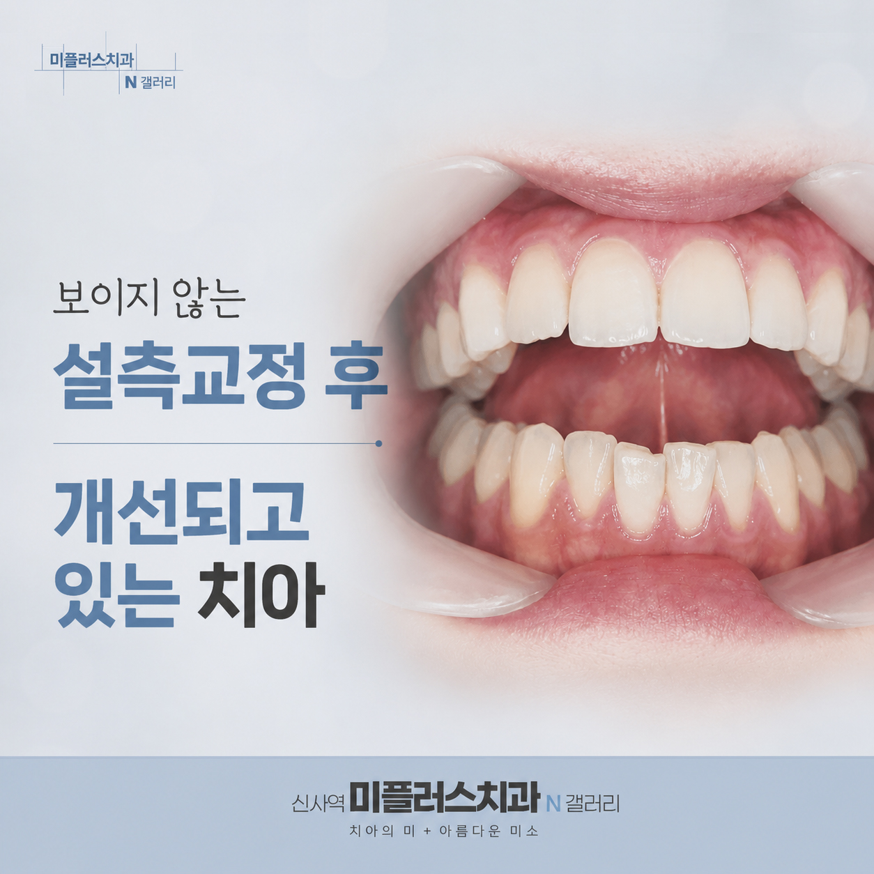 설측교정 후 치아 배열이 개선된 모습, 치아 안쪽 교정으로 심미성을 높인 사례 이미지
