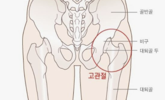 고관절 통증, 수술 없이 이렇게 나았습니다