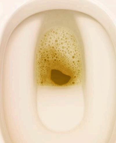 소변에 거품이 나는 이유