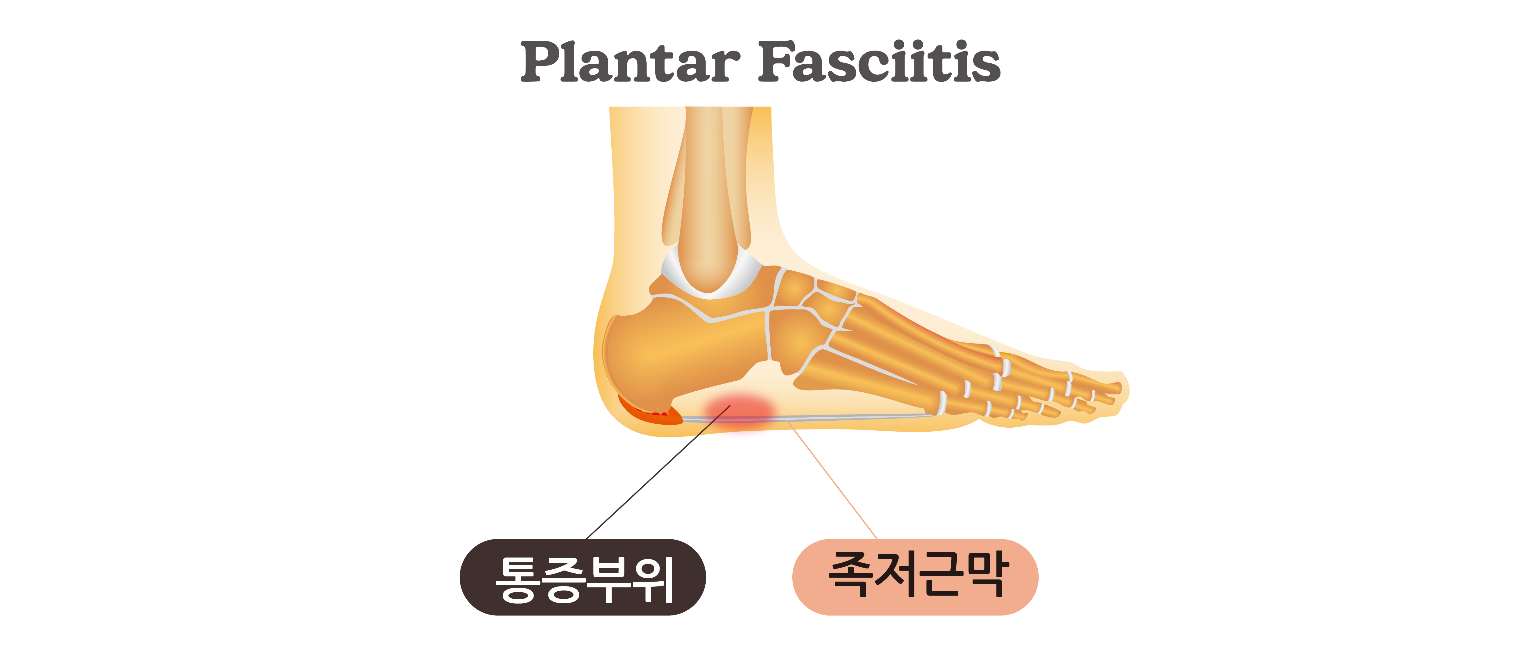 족저근막염 치료