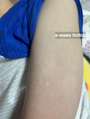 bcg 경피용 흉터