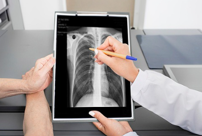 노년층 결핵 원인과 관리법