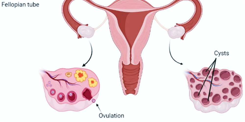 다낭성난소증후군