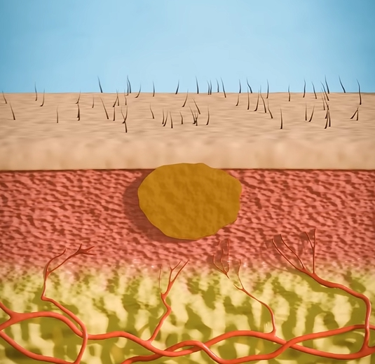 곤지름 초기증상