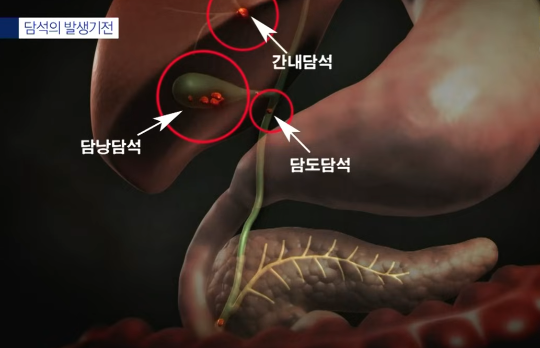 담석의 발생기전에 관한 사진