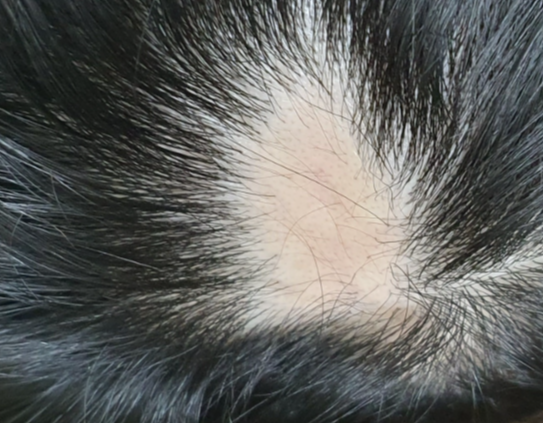 두피-탈모-동그랗게머리카락없음