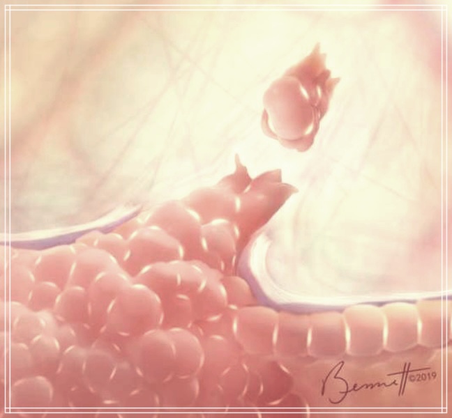 혈관종과 일반 종양의 차이점