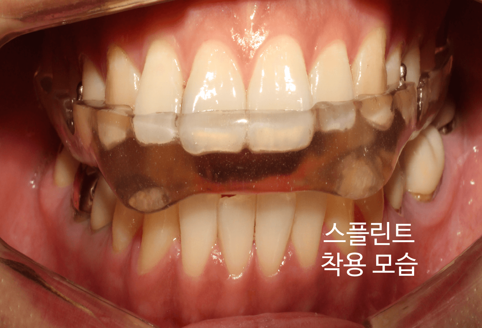 스플린트-착용-모습