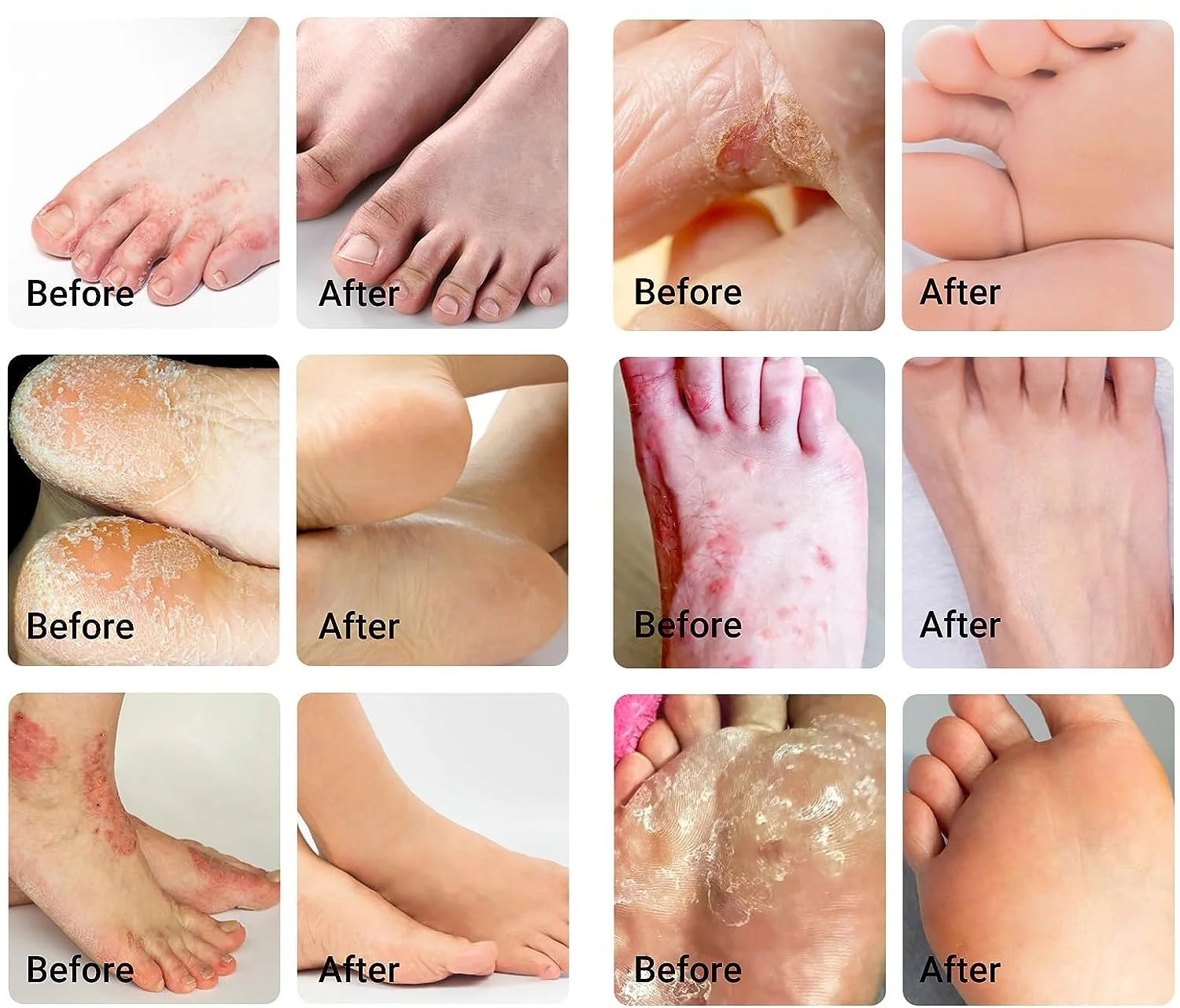 무좀약 : 무엇을 알아야 할까요?