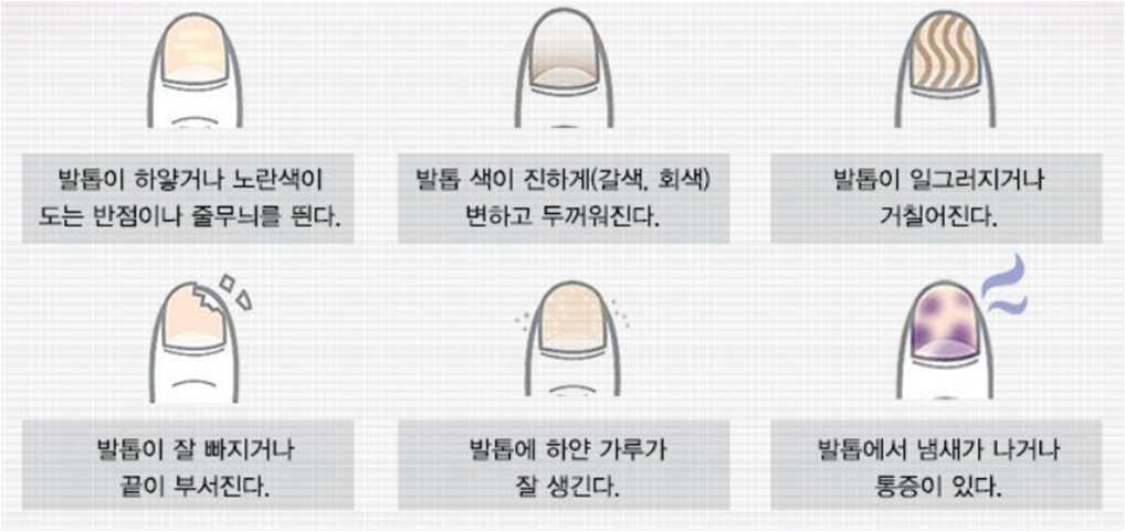 손발톱무좀, 발톱무좀