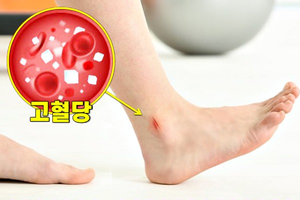 발 상처 당뇨발