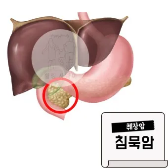 췌장암 초기 증상 췌장암 등통증 위치 검사_25