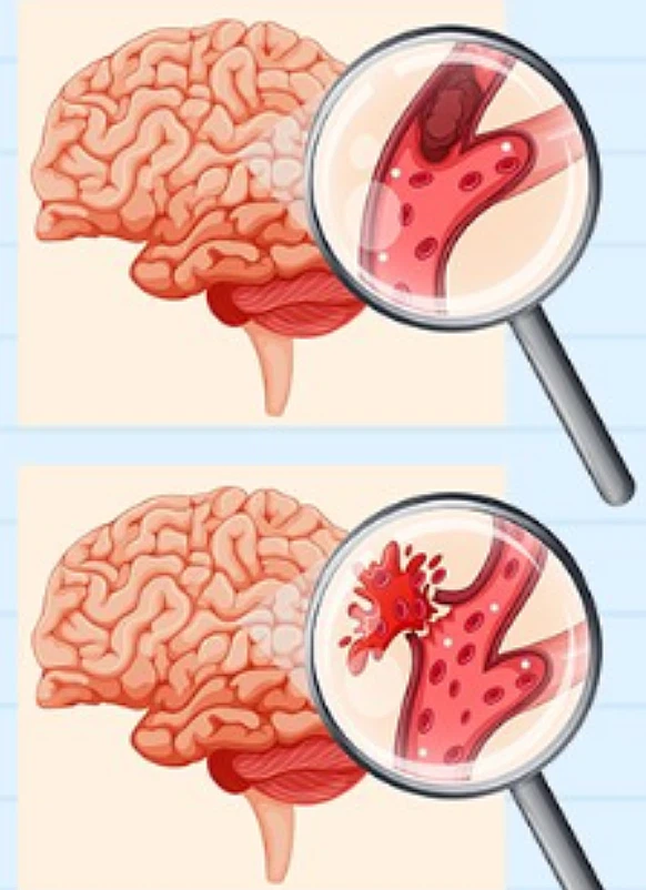 뇌졸중 전조증상