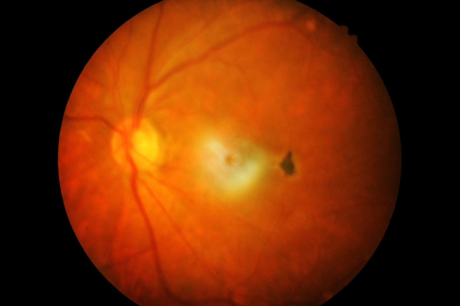 망막박리(Retinal Detachment)의 치료 방법