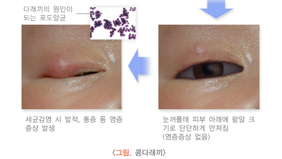 콩다래끼2