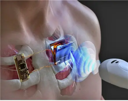 초음파를 활용한 인체 삽입형 전자기기