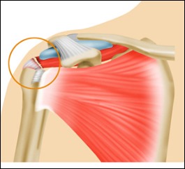 어깨통증 원인 2