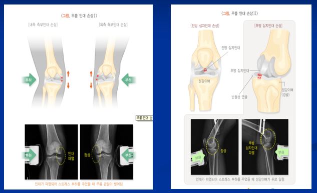 무릎 인대 손상