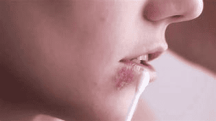 헤르페스가 생기는 이유와 관리 방법