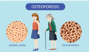 정상 골밀도와 골다공증 골밀도 비교 이미지