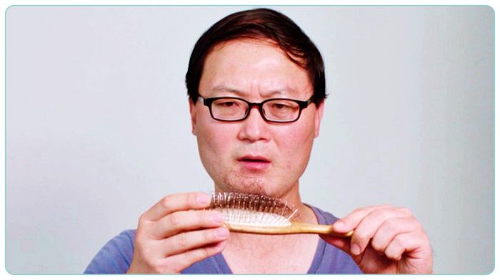 명의-원형-탈모