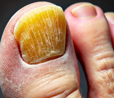 발톱이 검게 변하는 이유 - 발톱무좀