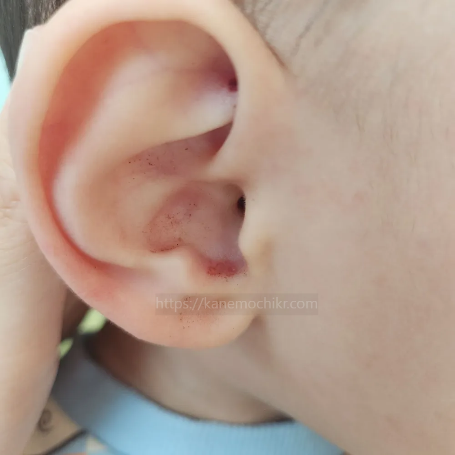 아기귀-알레르기