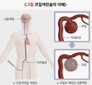 뇌동맥류와 지주막하출혈의 위험성 관련 이미지