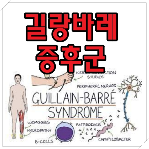 길랑바레 증후군 증상