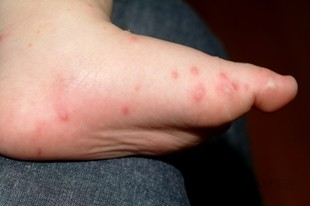 수족구, 수족구 증상, 수족구 초기 증상, 수족구 예방, 수족구 대처방법, 수족구 열, 수족구 수포