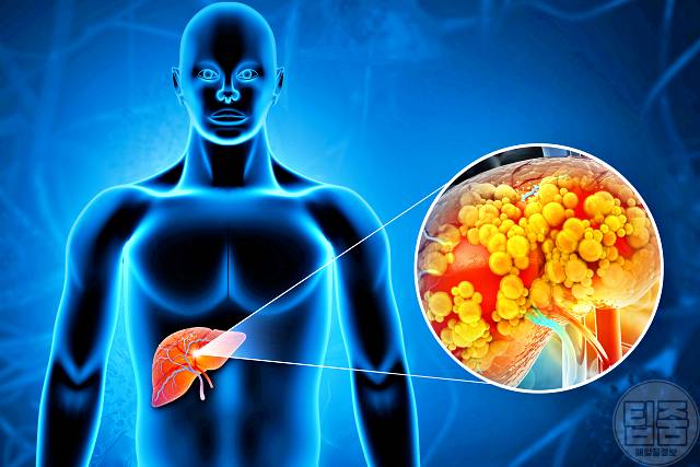 간암 증상 생로병사의비밀