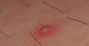 모낭염 증상&amp;#44; 원인&amp;#44; 치료 총 정리 (2025 최신)