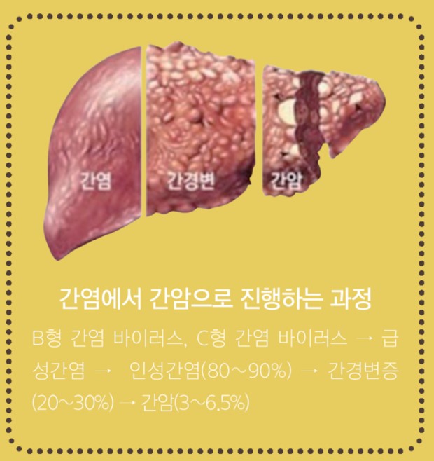 간암의 주요원인