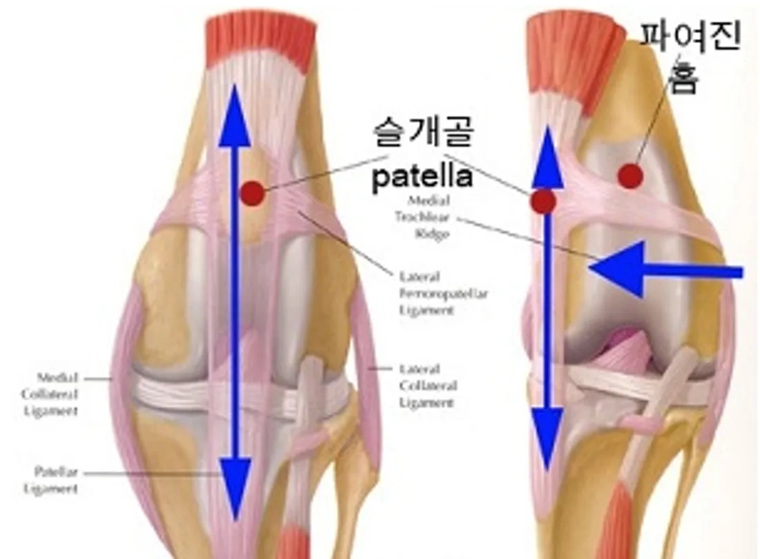강아지 슬개골 탈구 수술 후유증_7