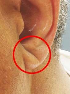 귀주름과치매와뇌졸중