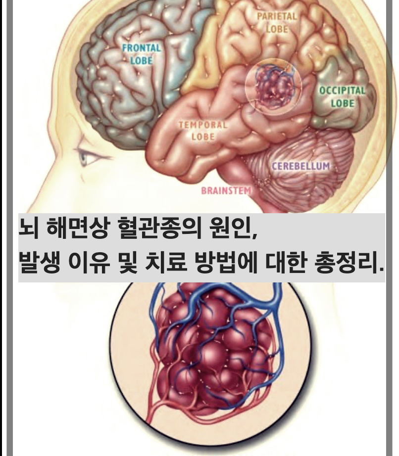 뇌 해면상 혈관종의 원인, 발생 이유 및 치료 방법에 대한 총정리.