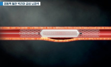 급성뇌경색