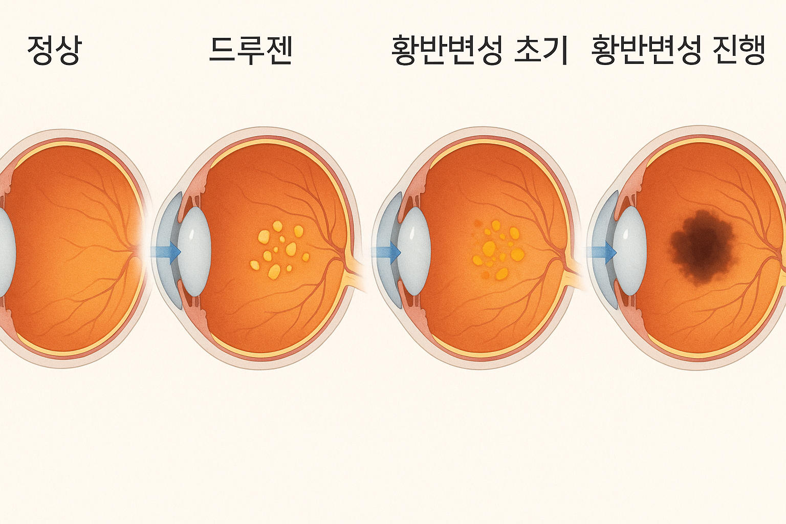 황반변성이 진행 과정