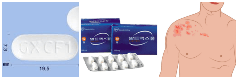 발트렉스정, 대상포진 사진