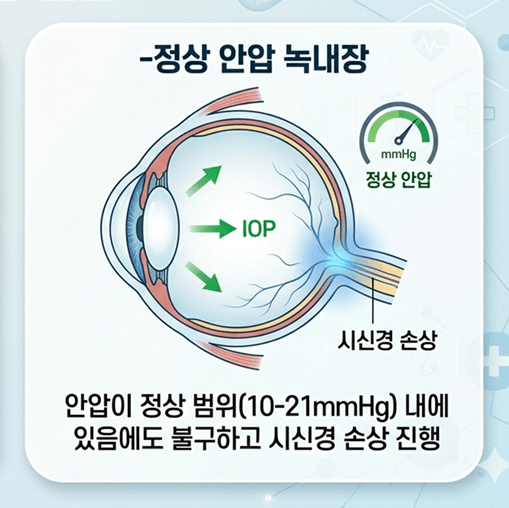 녹내장 원인
