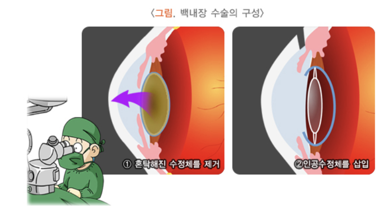백내장 수술의 구성