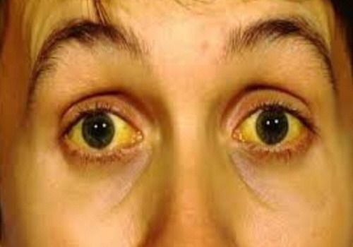 얼굴이 노래지는 이유