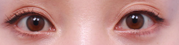 눈밑 지방재배치 비용과 회복기간